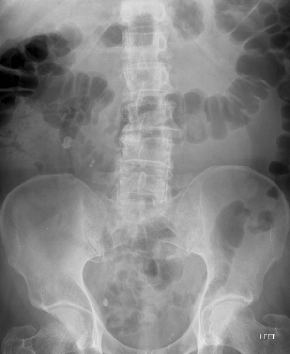 radiografie abdomen nativ