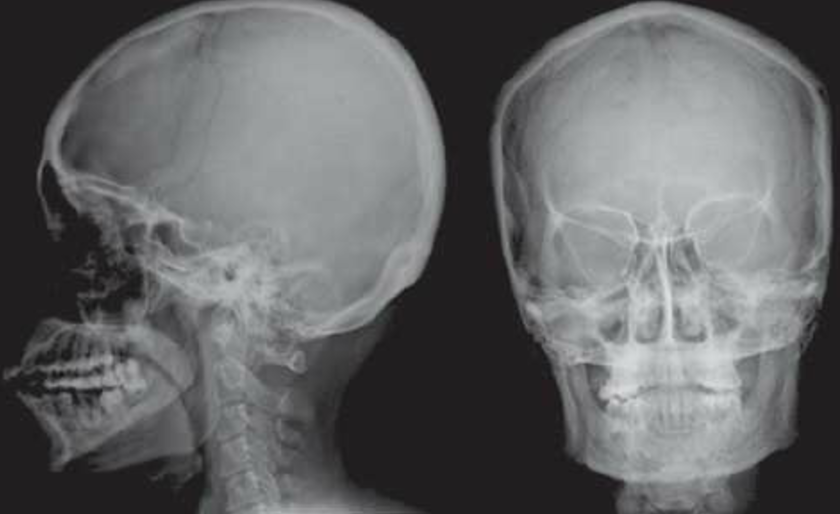 radiografie craniu