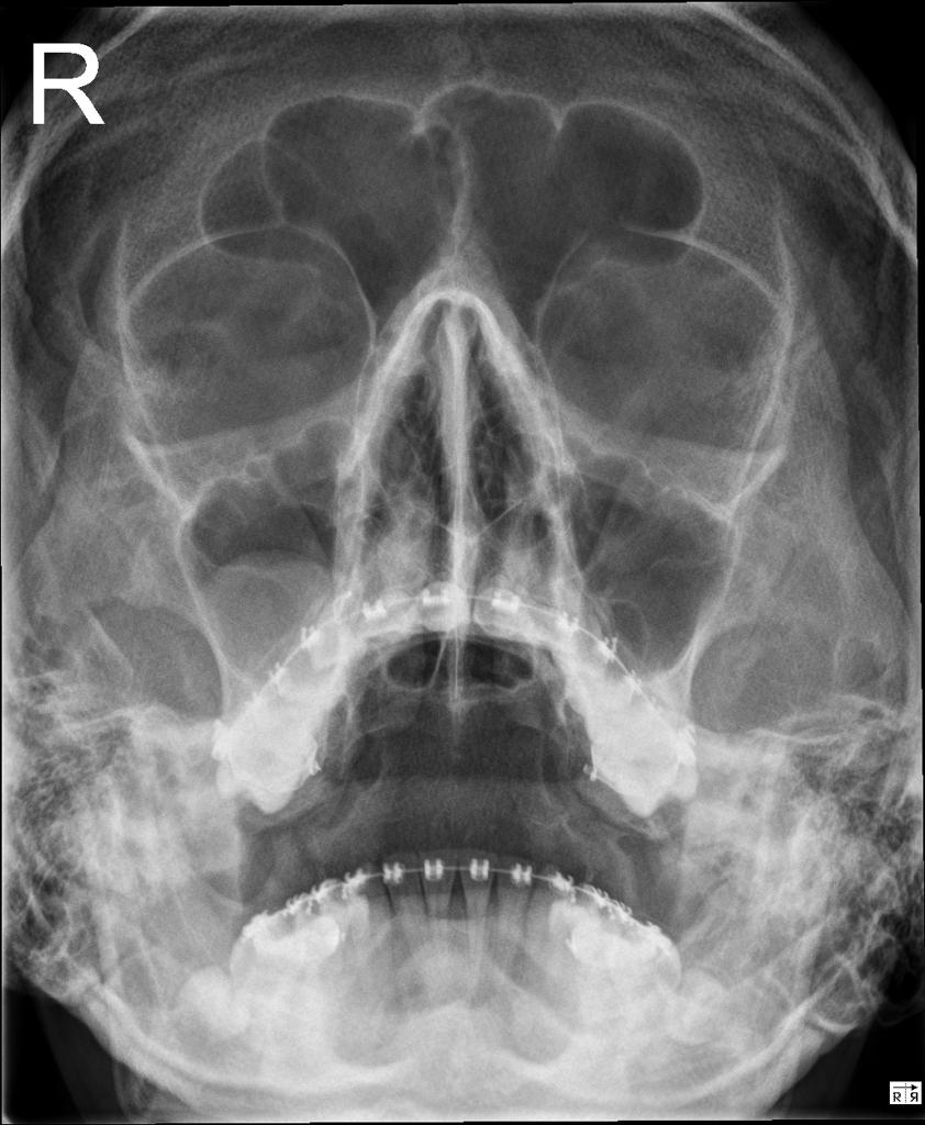 radiografie mandibula